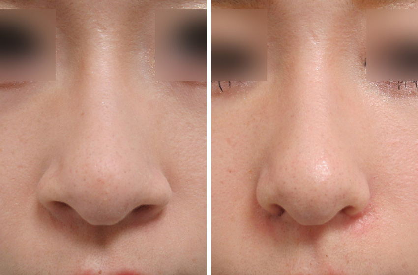 TAC式 鼻翼縮小術（小鼻縮小）の症例写真 施術前後 1週間