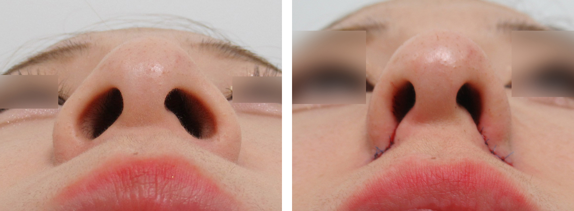 TAC式 鼻翼縮小術（小鼻縮小）の症例写真 施術前後 直後