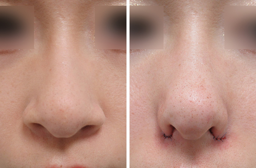 TAC式 鼻翼縮小術（小鼻縮小）の症例写真 施術前後 直後