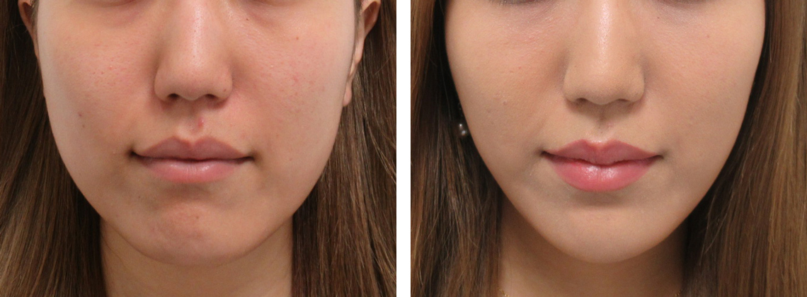 卵型のフェイスライン