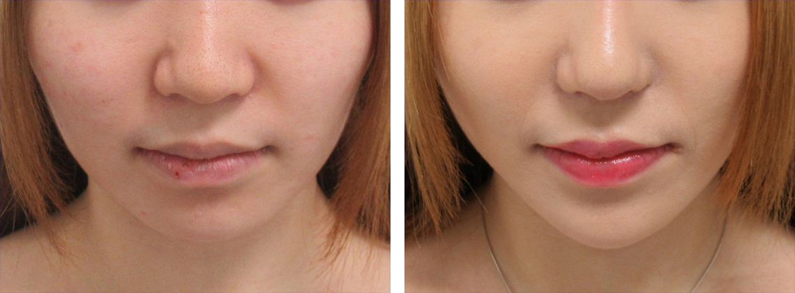 TAC式 ツヤ肌コラーゲンリフト®の症例写真 施術前後 1ヶ月