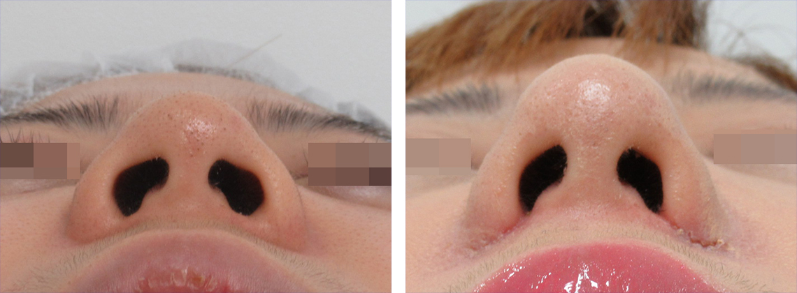 プロテーゼと鼻翼縮小で