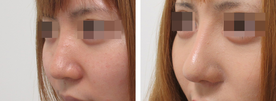 隆鼻術（プロテーゼ・自家組織）/TAC式 鼻翼縮小術（小鼻縮小）の症例写真 施術前後 １ヶ月
