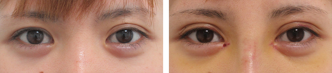 二重埋没法/目頭切開術の症例写真 施術前後 １週間