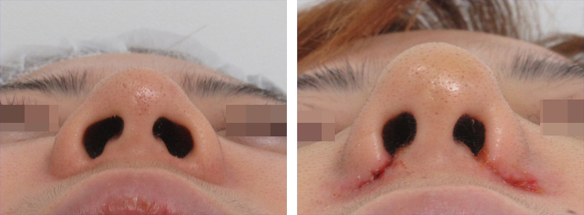 隆鼻術（プロテーゼ・自家組織）/TAC式 鼻翼縮小術（小鼻縮小）の症例写真 施術前後 １週間