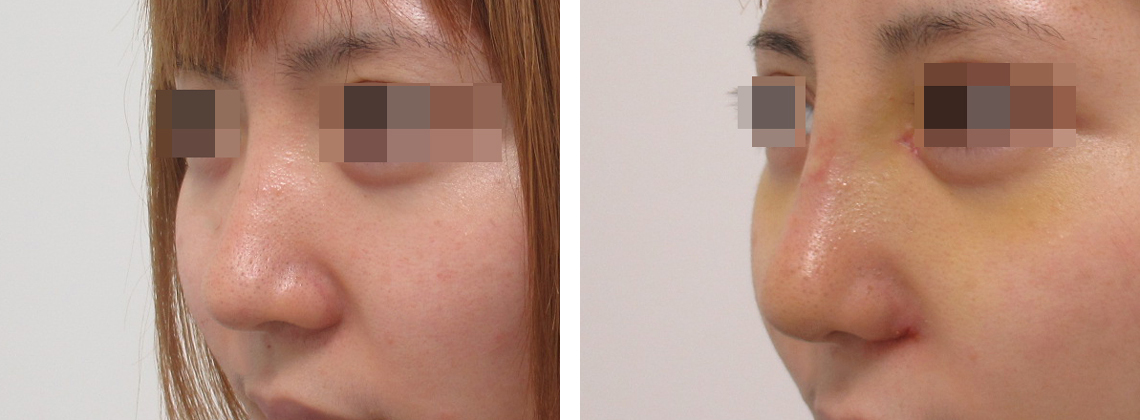 隆鼻術（プロテーゼ・自家組織）/TAC式 鼻翼縮小術（小鼻縮小）の症例写真 施術前後 １週間