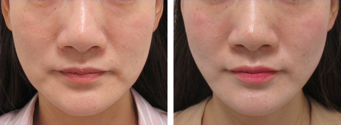 肌質改善効果もあります