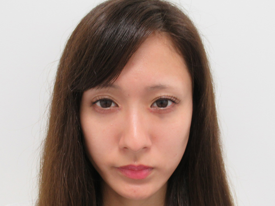 症例写真 ダウンタイム 面長な方もリフトアップで引き上げ Taクリニック 美容整形 美容外科 新宿 銀座 横浜 大阪 福岡 川越 高崎 Taクリニック 美容整形 美容外科