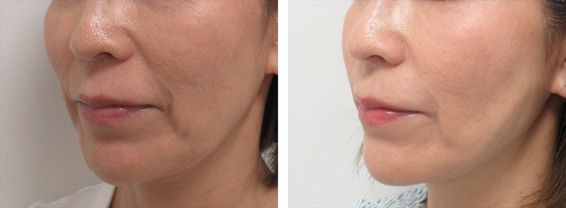TAC式 ツヤ肌コラーゲンリフト®/ヒアルロン酸注射：その他/ボトックス注射：その他の症例写真 施術前後 １ヶ月