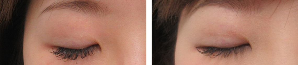 二重埋没法/眼瞼下垂（目つき矯正）の症例写真 施術前後 １ヶ月