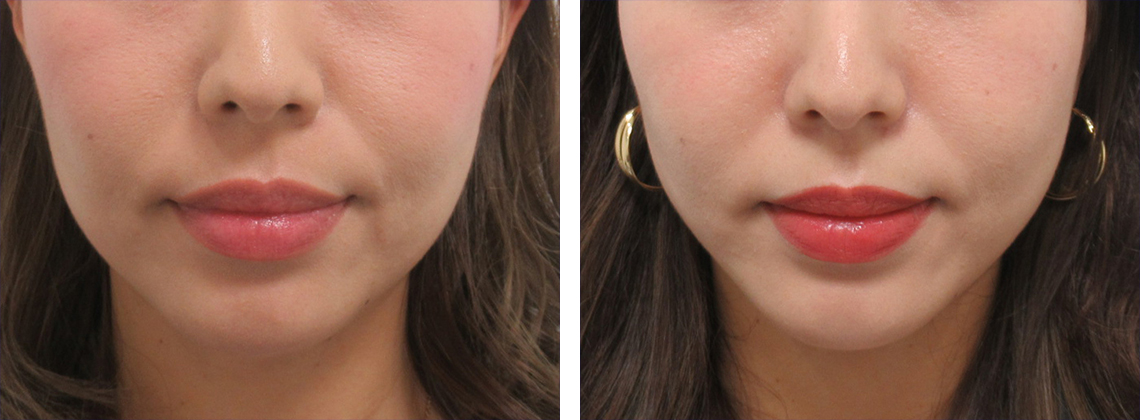 弾力が出ました