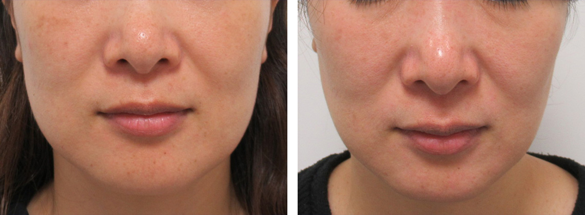 レブライトSI/エレクトロポレーション（電気穿孔法）の症例写真 施術前後 ３回