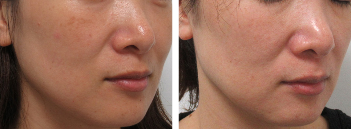 レブライトSI/エレクトロポレーション（電気穿孔法）の症例写真 施術前後 ３回