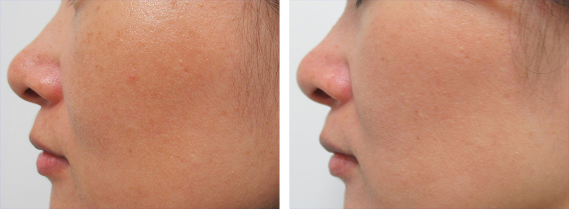 レブライトSI/エレクトロポレーション（電気穿孔法）の症例写真 施術前後 ３回