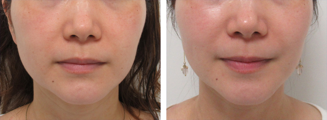 レブライトSI/エレクトロポレーション（電気穿孔法）の症例写真 施術前後 ５回照射