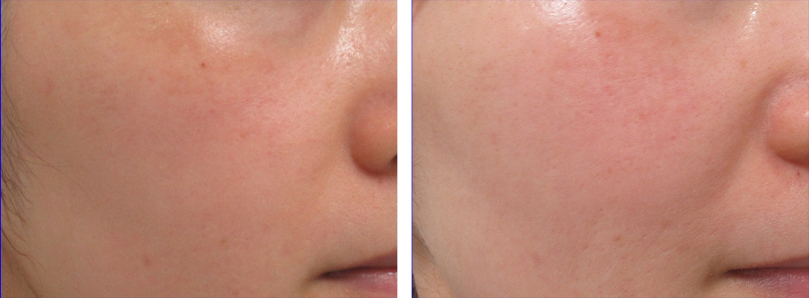 レブライトSI/エレクトロポレーション（電気穿孔法）の症例写真 施術前後 ５回照射