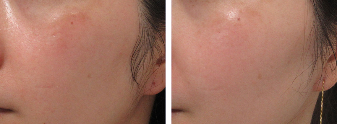 肝斑治療の症例です