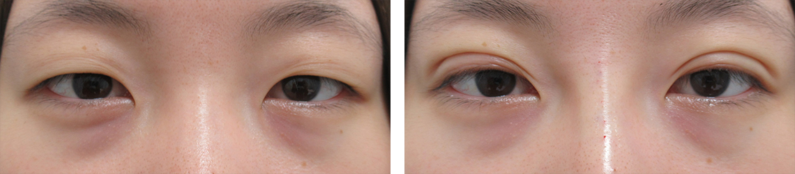 二重埋没法の症例写真 施術前後 直後