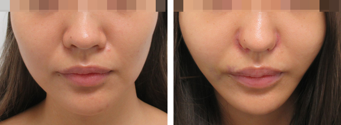 TAC式 ツヤ肌コラーゲンリフト®/ボトックス注射:その他の症例写真 施術前後 1週間