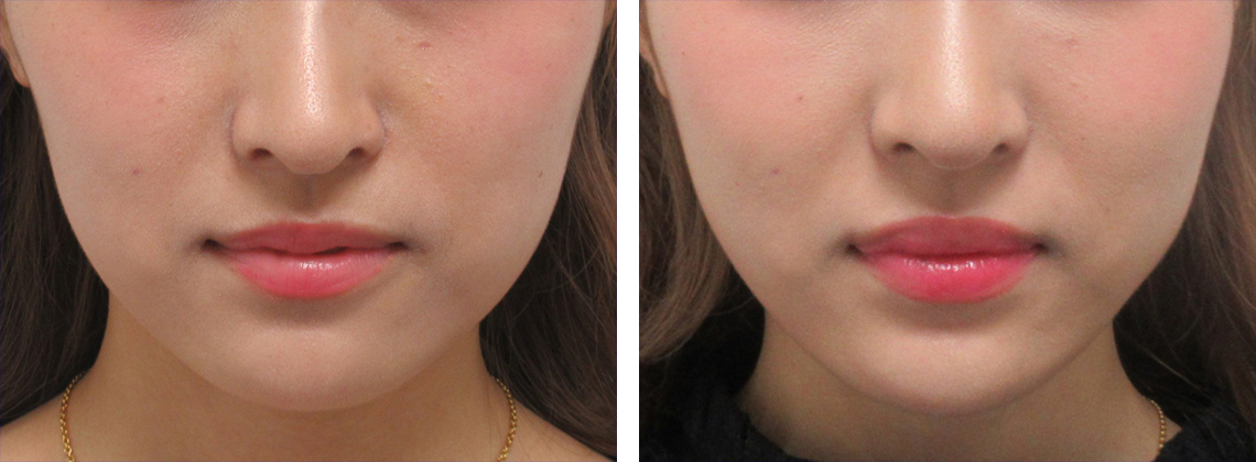 ちょい足しでフェイスラインが整います