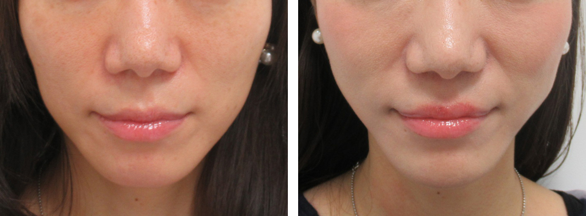 お肌のハリがお写真でもわかります