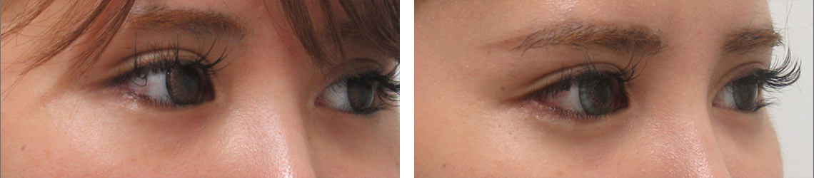 目尻切開術の症例写真 施術前後 １ヵ月（目尻切開のみ）