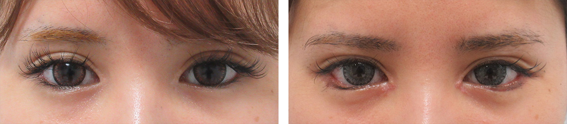 グラマラスライン(タレ目形成)/目頭切開術の症例写真 施術前後 1週間