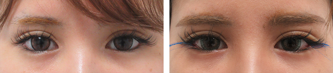 目尻切開術の症例写真 施術前後 １週間（目尻切開のみ）