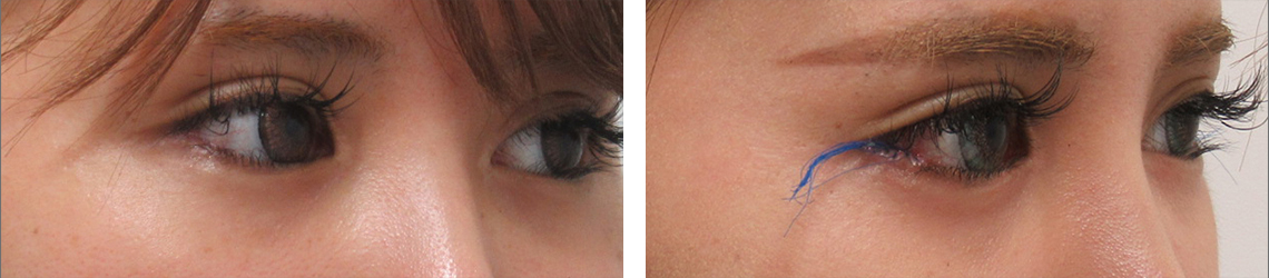 目尻切開術の症例写真 施術前後 １週間（目尻切開のみ）