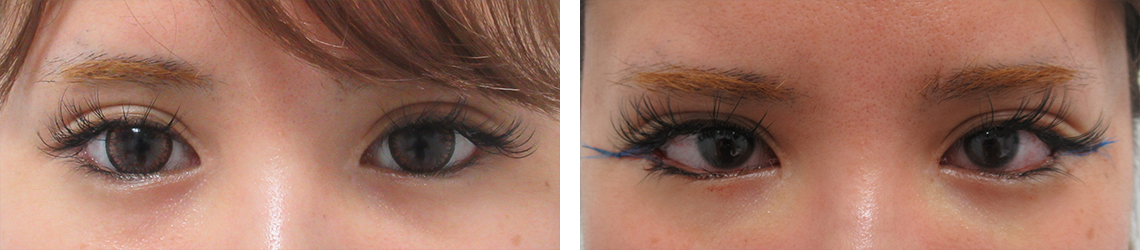 目尻切開術の症例写真 施術前後 直後（目尻切開のみ）