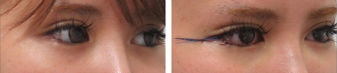 目尻切開術の症例写真 施術前後 直後（目尻切開のみ）