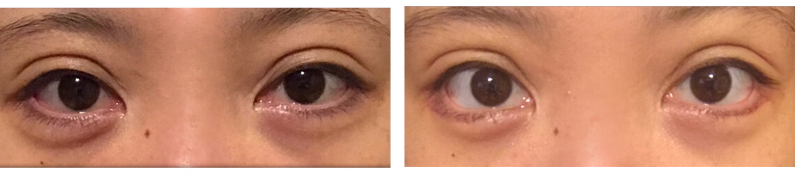 二重埋没法/グラマラスライン（タレ目形成）の症例写真 施術前後 