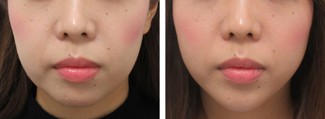 頬の肉を減らしてリフトアップ