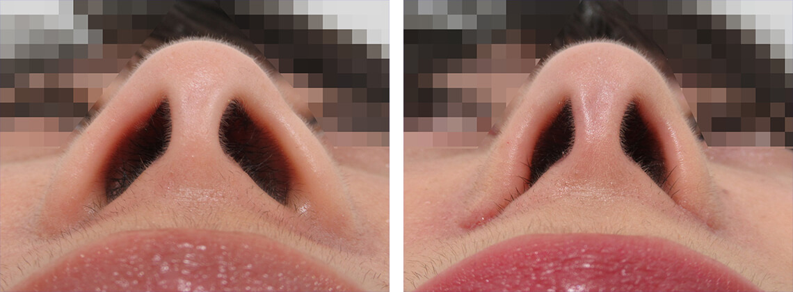 鼻翼縮小術の下からの症例