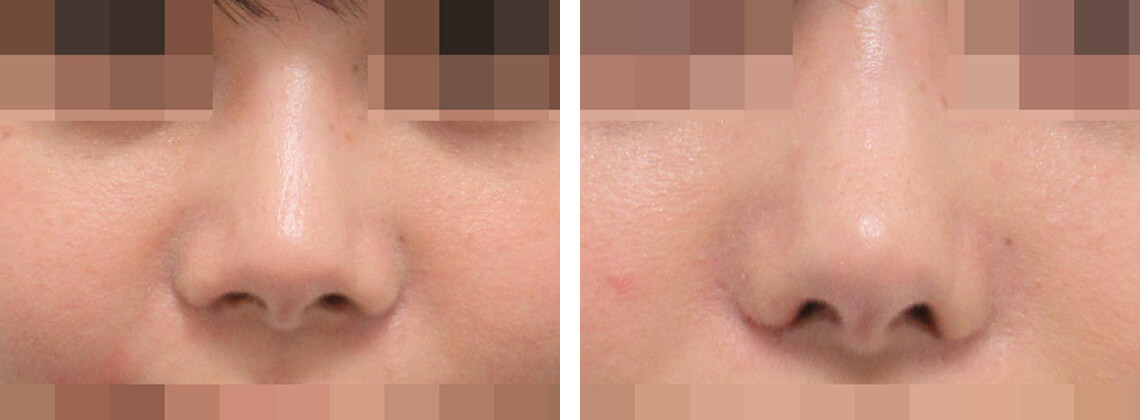 鼻翼縮小術の正面からの症例