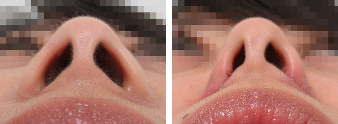 TAC式 鼻翼縮小術（小鼻縮小）の症例写真 施術前後 １週間