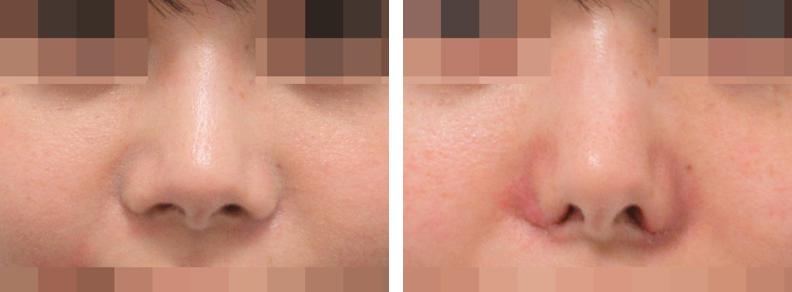 TAC式 鼻翼縮小術（小鼻縮小）の症例写真 施術前後 １週間