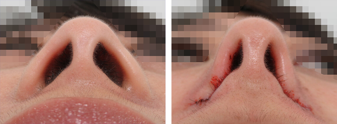 TAC式 鼻翼縮小術（小鼻縮小）の症例写真 施術前後 直後