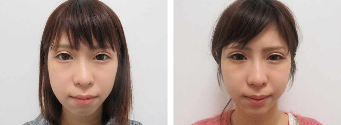 左右差はありますが引き上がります