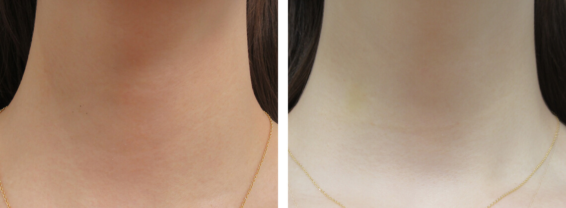 の症例写真 施術前後 １週間