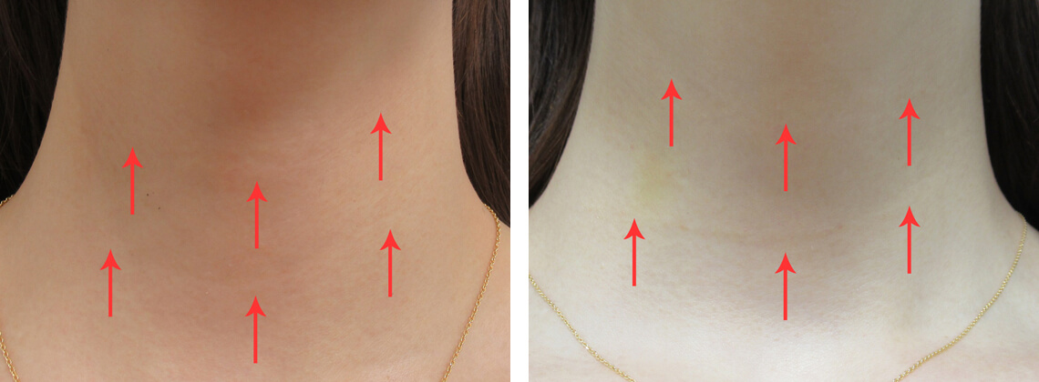 首の横ジワにベビーコラーゲン