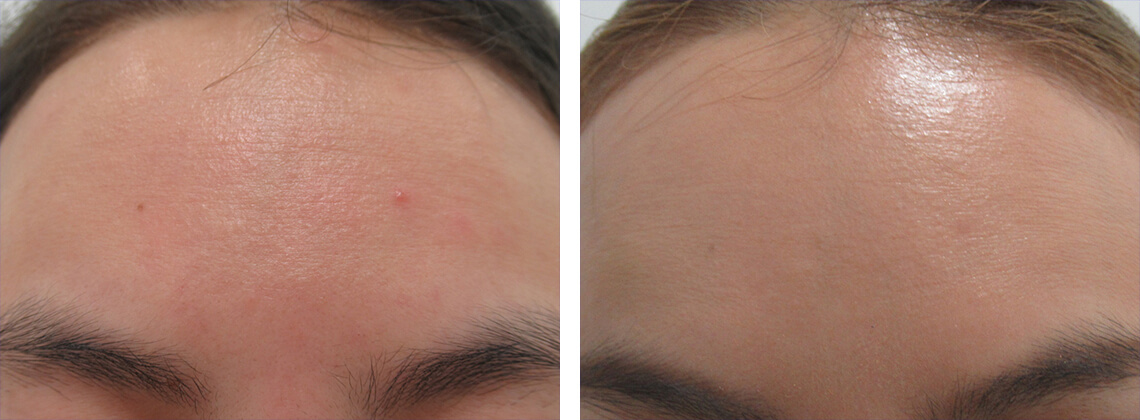 水光注射で額のケアを