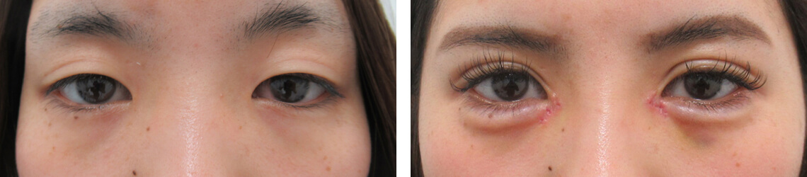 二重埋没法/目頭切開術/涙袋形成（ヒアルロン酸注射）の症例写真 施術前後 １週間