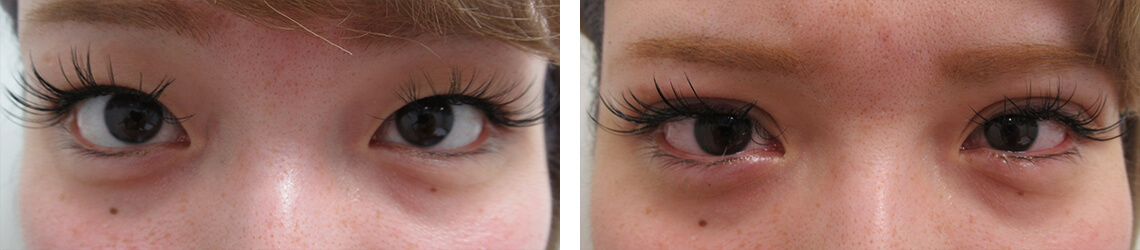 二重埋没法の症例写真 施術前後 直後