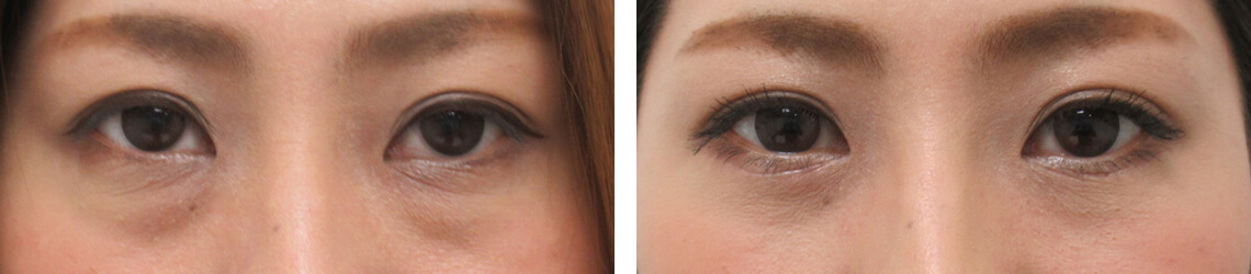 目の下のたるみクマ改善