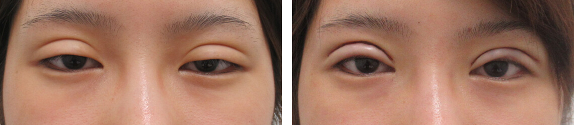 眼瞼下垂（目つき矯正）/上眼瞼切開術の症例写真 施術前後 直後