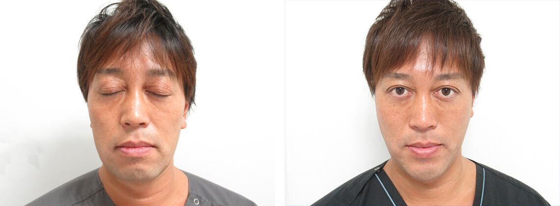 嶽崎医師のTAC式 ツヤ肌コラーゲンリフト症例