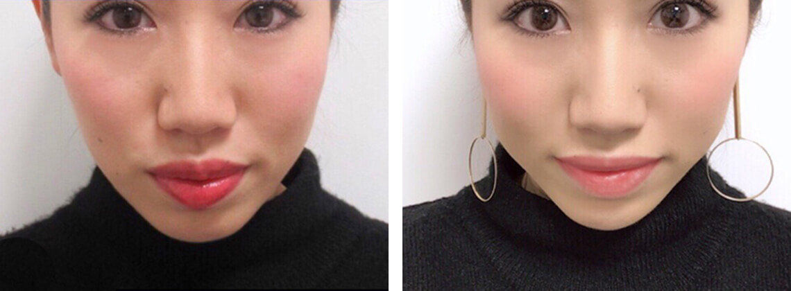 夏瀬ゆうな様のTAC式 ツヤ肌コラーゲンリフト症例