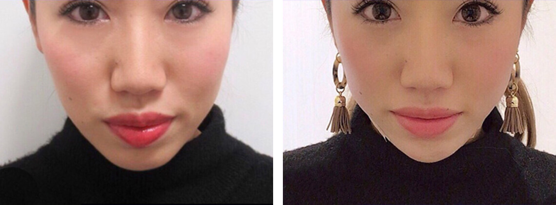 TAC式 ツヤ肌コラーゲンリフト®/ヒアルロン酸注射：その他の症例写真 施術前後 直後