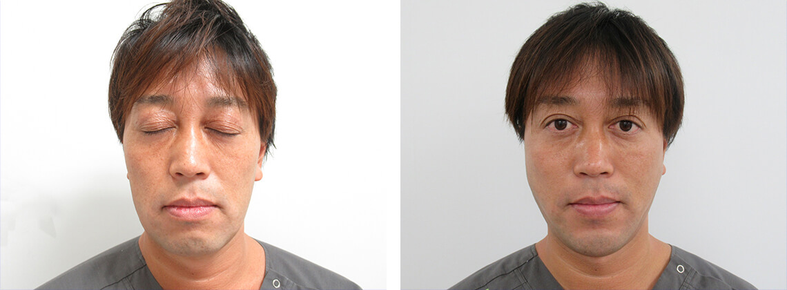 TAC式 ツヤ肌コラーゲンリフト®/顎のヒアルロン酸注射/エラボトックス注射の症例写真 施術前後 １週間